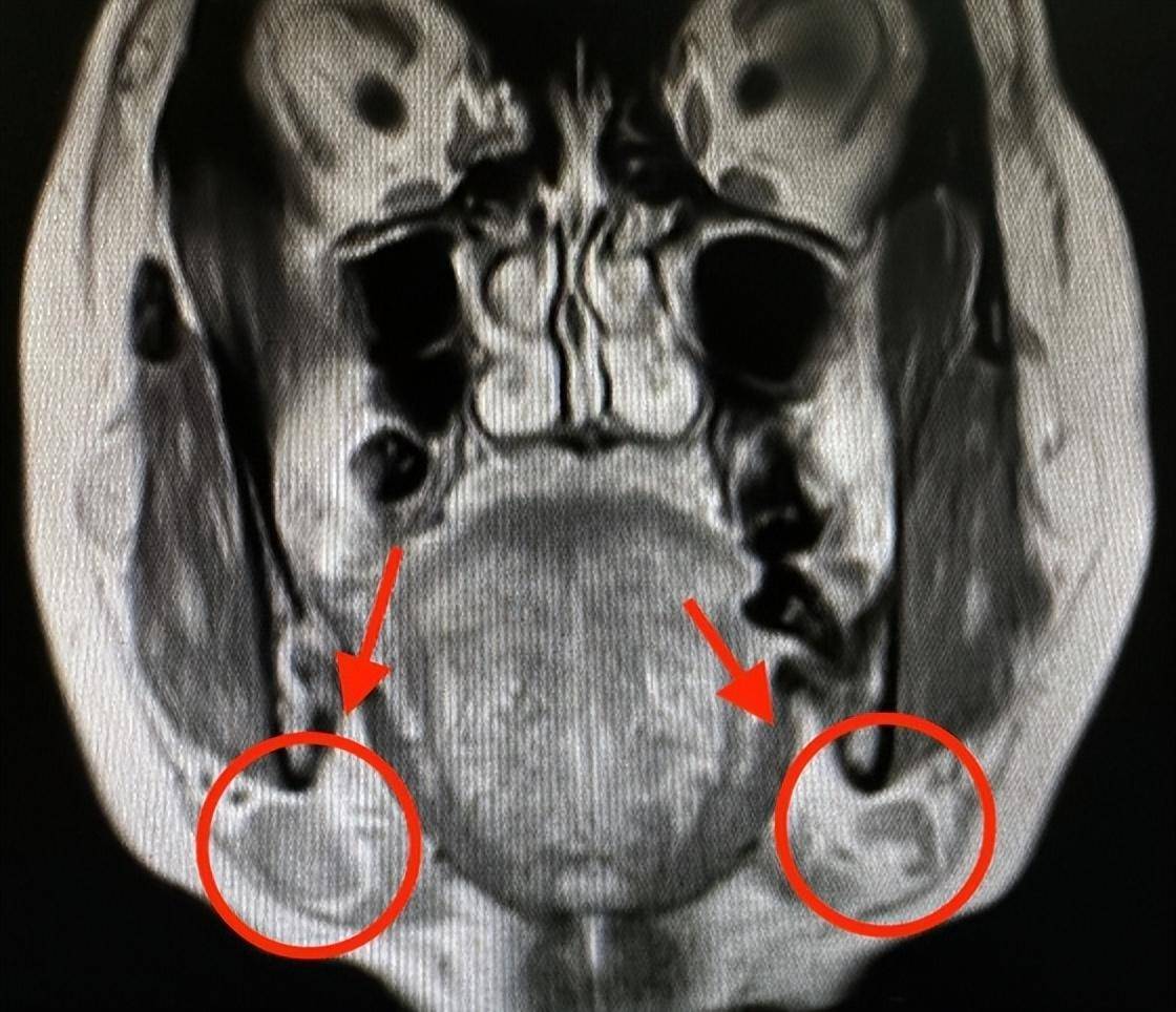 舌癌核磁共振报告图片图片