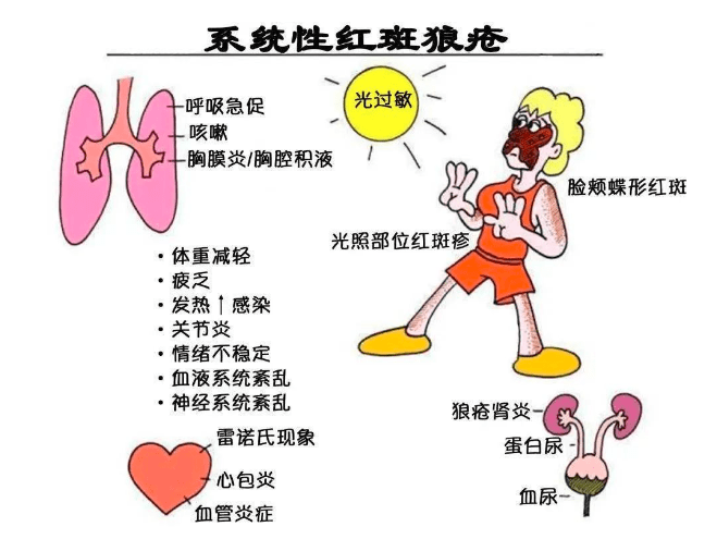 夺走周海媚的红斑狼疮究竟是怎样一种可怕的疾病?_患者_治疗_系统性
