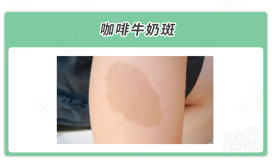 宝宝身上哪种胎记会对孩子产生危害？