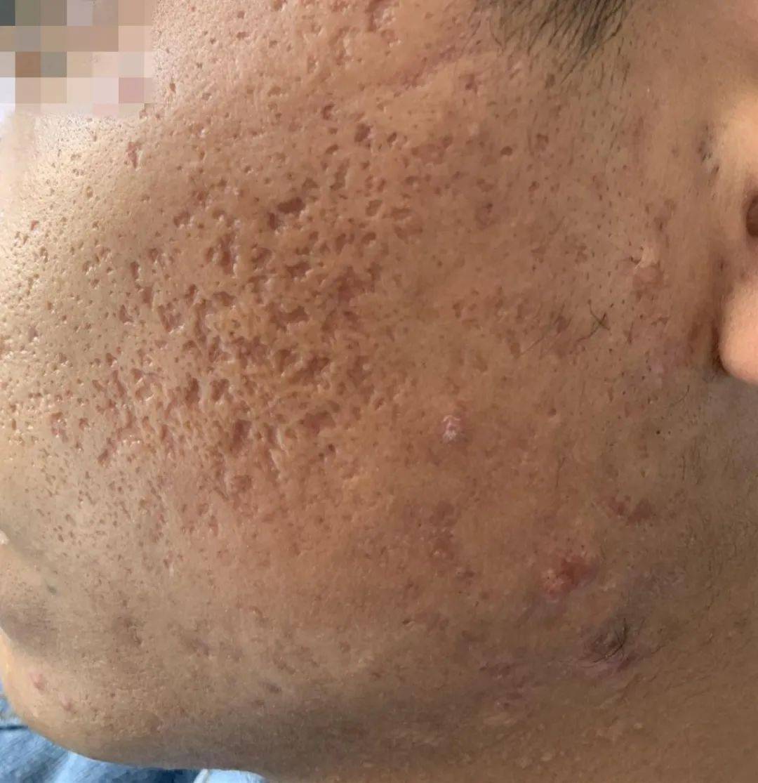 【昆明皮肤病医院治疤案例】第10期:双侧下颌痤疮后遗留瘢痕疙瘩治疗