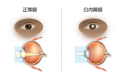 我們的晶狀體正常情況下是透明的,無論什麼原因導致它出現混濁不透明