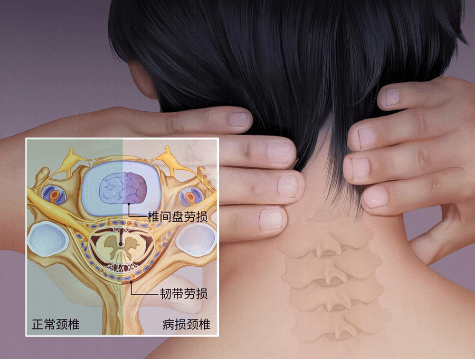 求頸椎病康復辦法_工作_肌肉_按摩