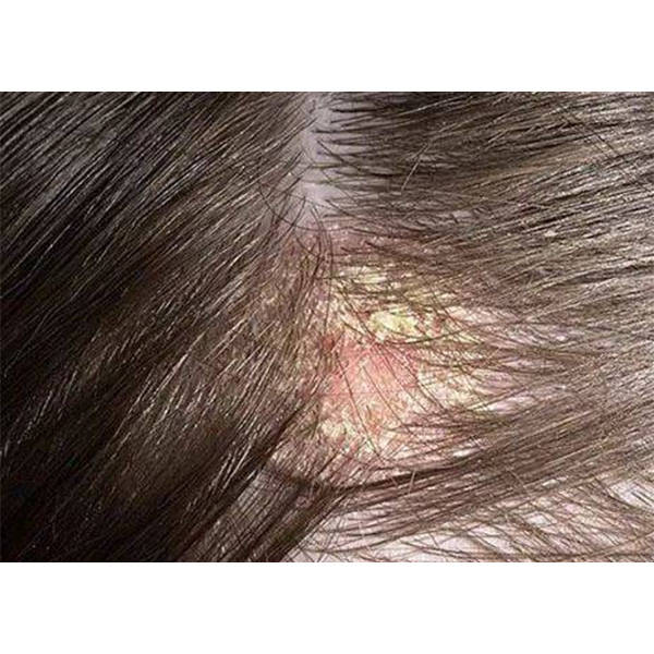 男童10岁头皮屑多能怎么解决