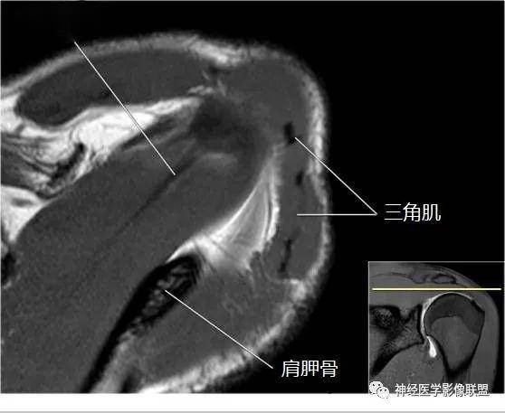 断层解剖 | 肩关节磁共振_手机搜狐网