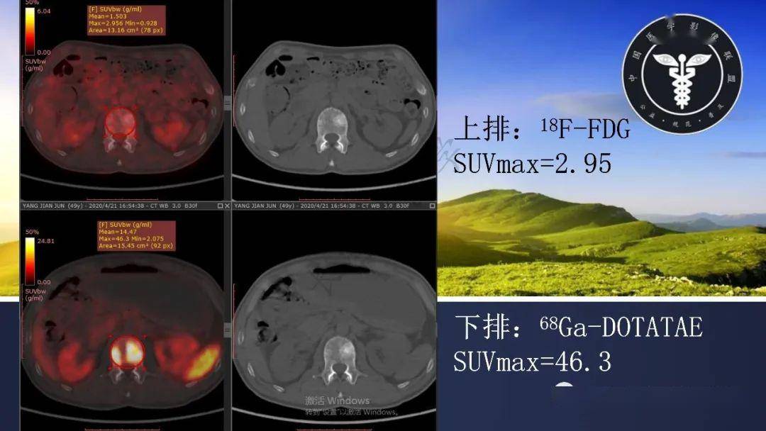 肠管丨直肠神经内分泌瘤伴多发骨转移