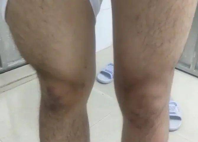 膝盖肌肉萎缩图图片