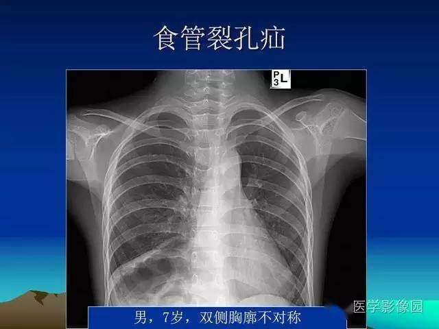 膈疝影像学表现