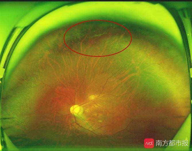 雙眼近視過千度 視網膜悄然病變600° 可免費查眼底了