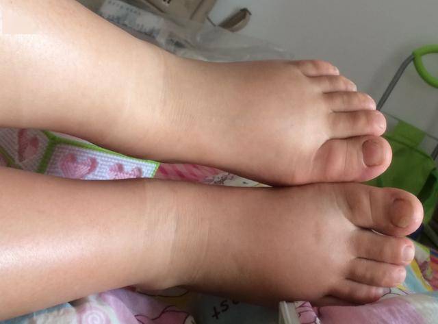 7个月的宝宝全身水肿呕吐不止检查后医生直言喝水喝的