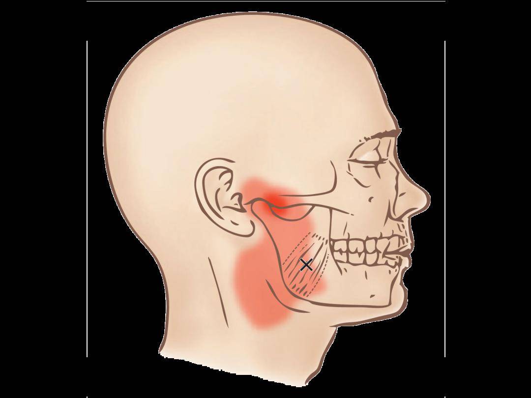 翼内肌扳机点会导致颞下颌关节和耳朵疼痛,咬合时疼痛会加剧