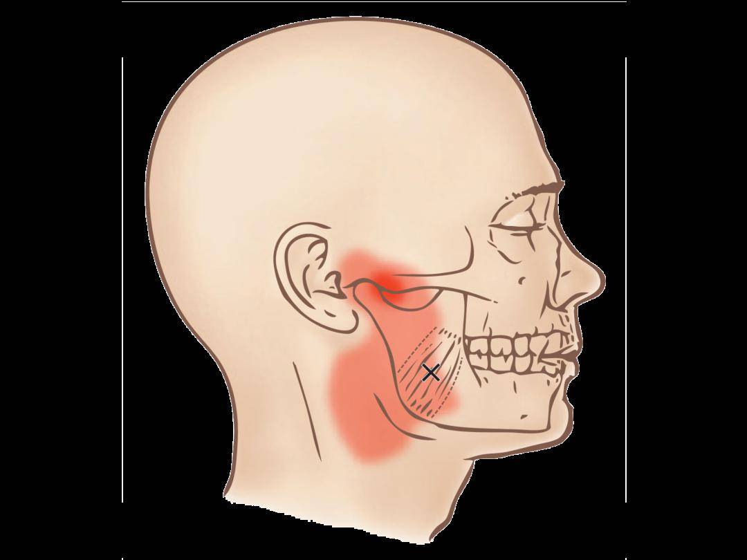 翼內肌扳機點會導致顳下頜關節和耳朵疼痛,咬合時疼痛會加劇.