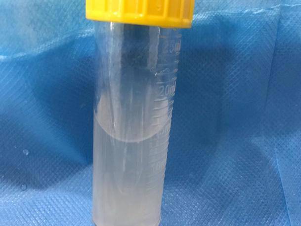 潍坊首例!支气管镜肺泡灌洗成功救治出生2天新生儿