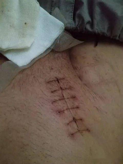 ②切口护理:术后切口一般不需加沙袋压迫,有切口血肿时应予适当加压