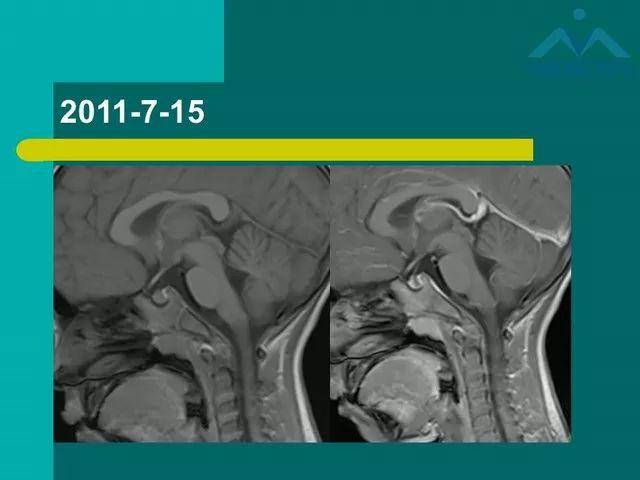 儿童rathke裂囊肿的影像与临床