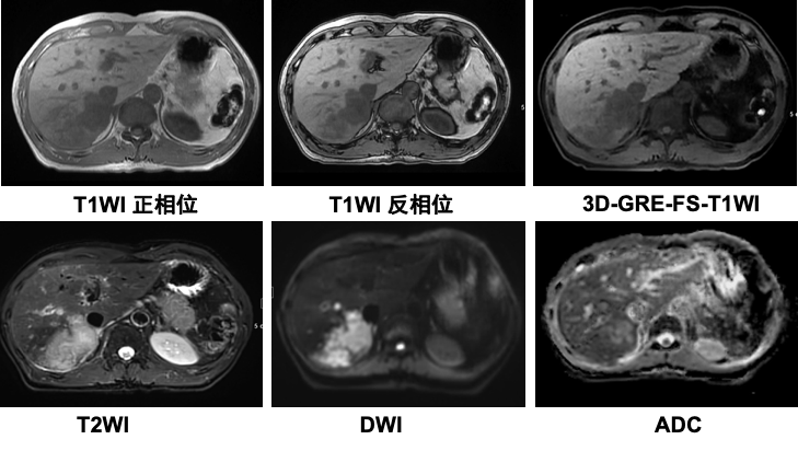 搞定这3个问题零基础也能读懂腹部mri