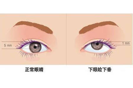 眼睑下垂和肌无力的区别