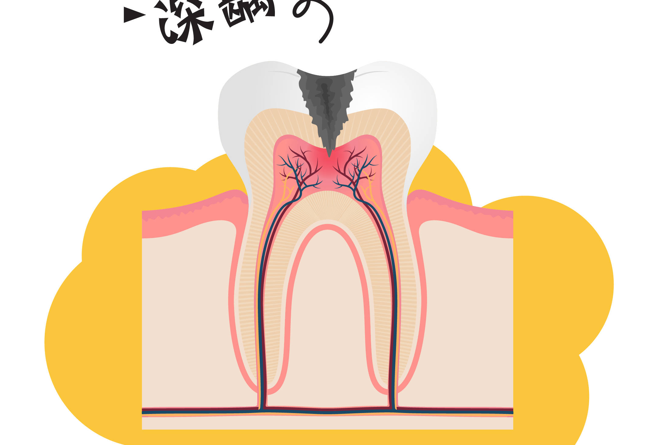 蛀牙烂到牙神经需要多久？-爱康健齿科