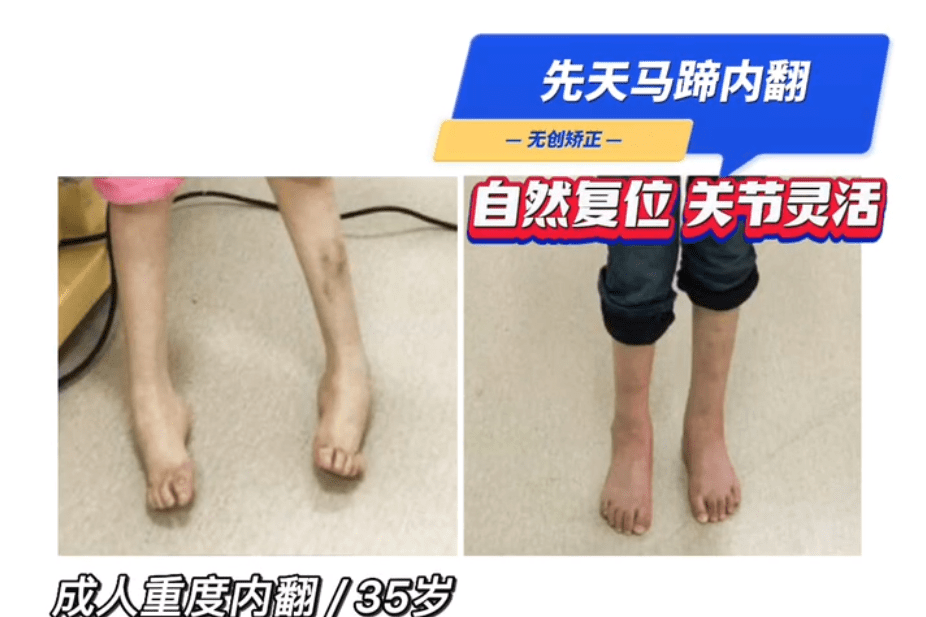 成人重度先天性马蹄足内翻畸形的几个典型病例