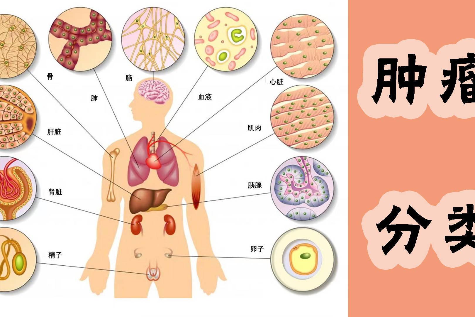 肿瘤分为哪几种 来自搜狐网