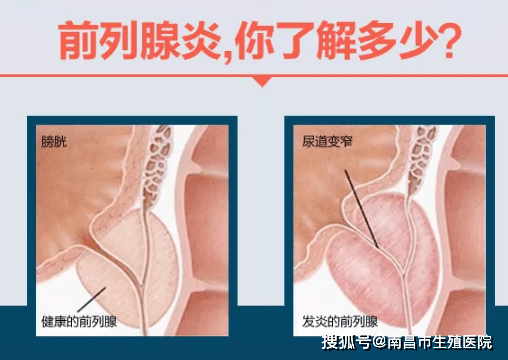 什么原因会引起尿路炎症 61847f06359845088edd99459f6d4c8a.png