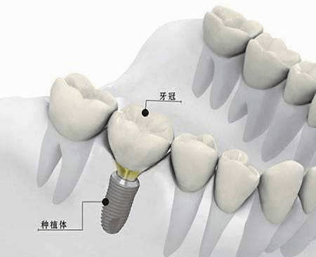 口腔环境的种植牙系统为佳.