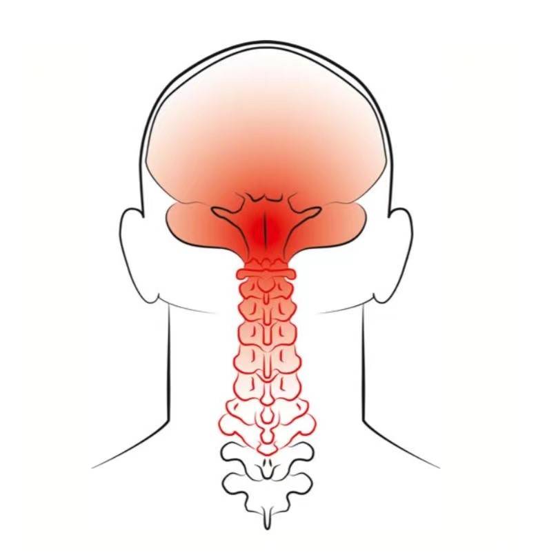经常头痛竟是由颈椎引起 想要缓解 需要做好以下几点 颈源