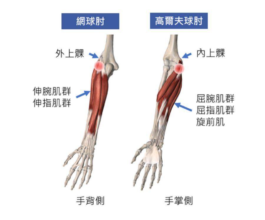 为旋前屈肌群肌腱起始部过度疲劳而引起的损伤,高尔夫球肘是高尔夫球