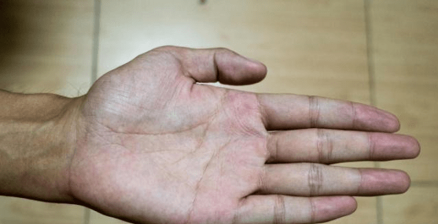 血管堵塞时,手部会出现3个症状,提醒您:该注意身体了!_指甲_手心_因为