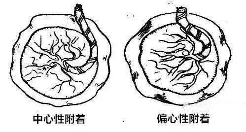 【醫問到底】什麼是帆狀胎盤