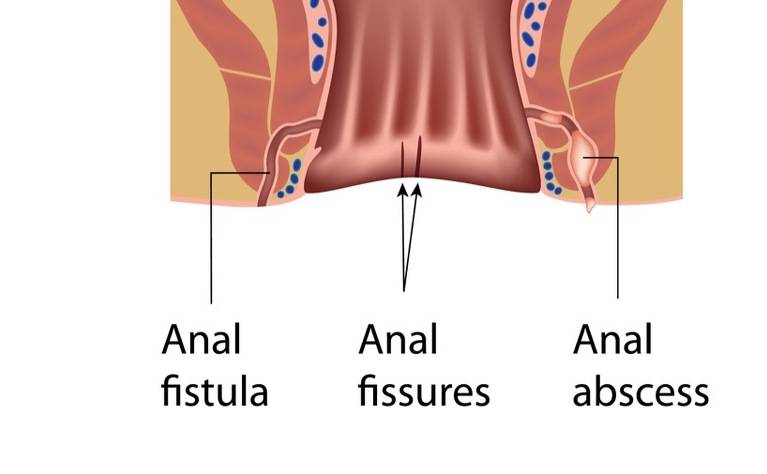 肛裂是指在肛门和肛管周围的皮肤中形成的裂口或疮.