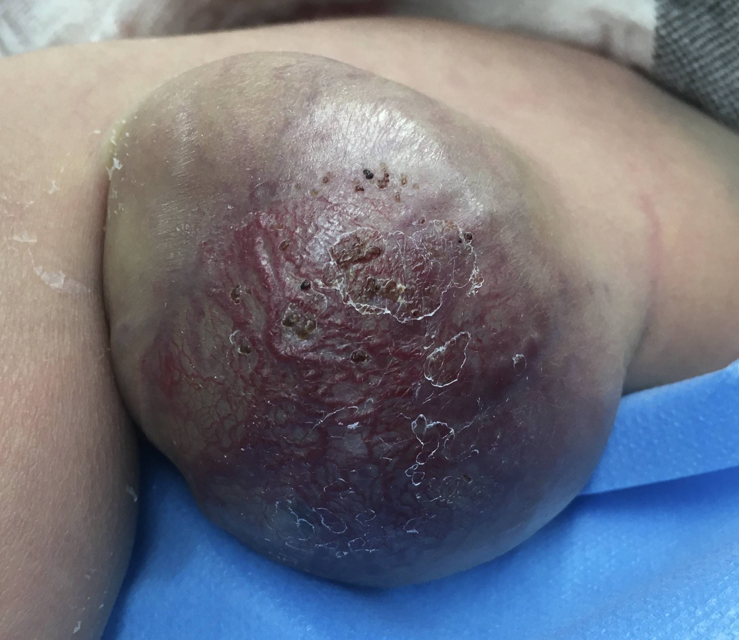 徐州儿童介入专家李炯小儿血管畸形不留疤首选介入治疗