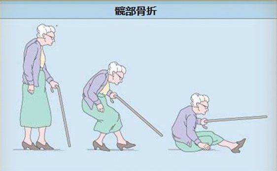 莫让老人髋部骨折成了最后一次骨折