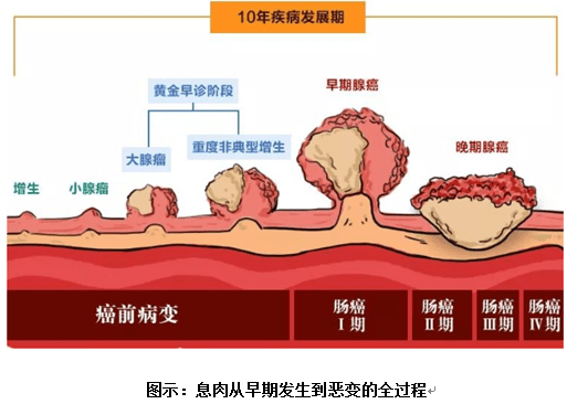 濟南胃康醫院提醒您保護腸道健康腸息肉不可不防