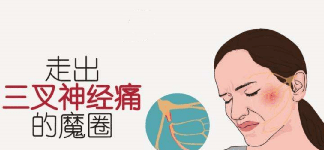 怎样才能有效的治疗三叉神经痛 de543738ac5b40b989709af6b341b6fd.png