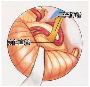 什麼是球囊壓迫術治療治療三叉神經痛效果好不好來聽聽專家的看法