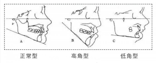 曲线|圣嘉新邱立东：下颌角截骨是否应该保留角度？