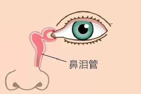 一般鼻泪管堵塞初期采用泪囊局部压迫按摩法,可在家进行按摩治疗