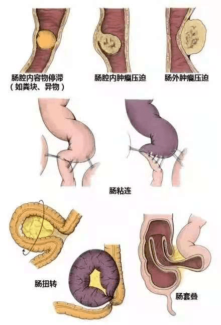 肠梗阻的症状图片
