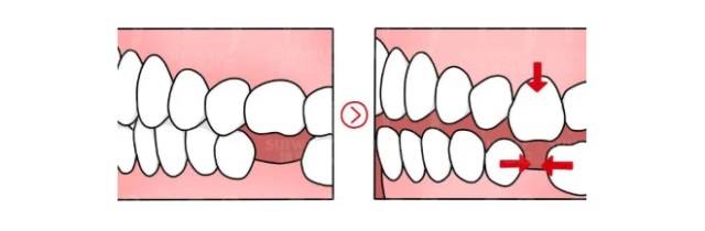 对颌牙伸长,邻牙倾倒,余牙移位……时间越久,咬合关系破坏越严重,当单