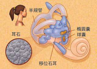 貴陽銘仁耳鼻喉醫院耳石症與美尼爾氏綜合症的鑑別與治療