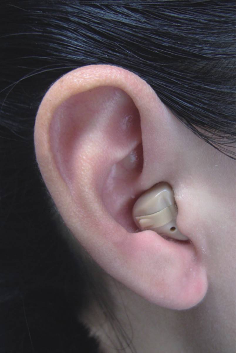 老年人助听器之老年人听力下降,竟是高血脂在捣乱