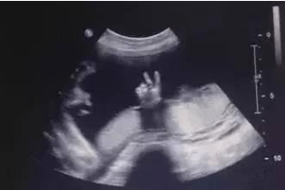 超声|【医问到底】产前四维过了，还需要做心脏彩超吗？