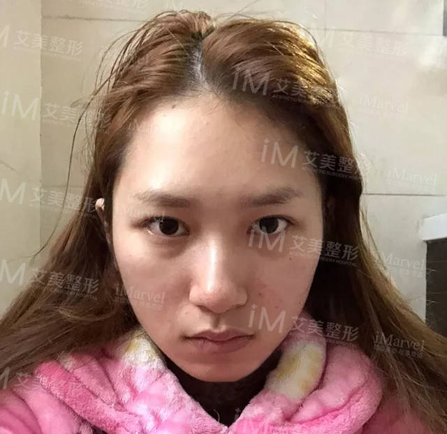 朋友|为了美丽，对自己下手“狠的人”真的很多，达芬奇定制美眼为啥她点名了非要做