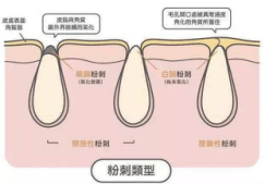 角栓|聂亮亮老师-你的毛孔为何比别人的大