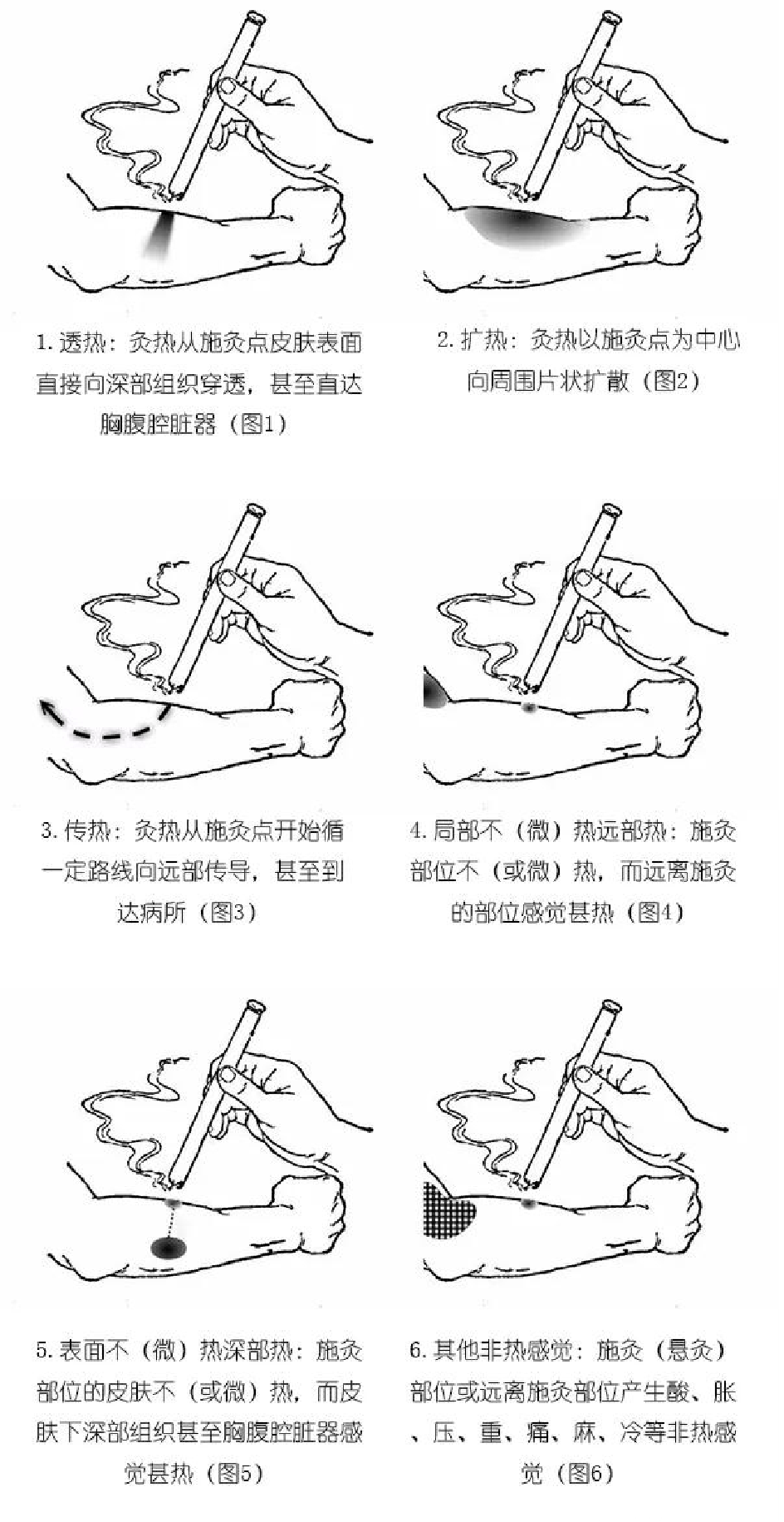 神奇的热敏灸