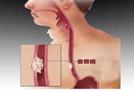 食道癌能活多久?nk细胞疗法效果?