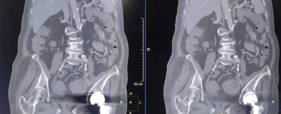 髋关节|影像检查遭遇金属植入物怎么办？三中心放射科巧妙解决“金属伪影”