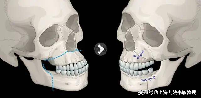 下颌骨错位脸歪怎么办