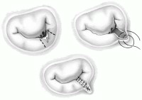 治疗|反复发烧2个多月，17岁女孩患的这种少见病经高难手术精巧治愈