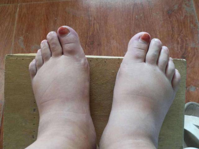 肾脏|尿毒症2年,19岁被父母遗弃:她身上的伤肾习惯,很多人都有